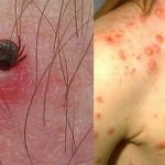 Exhorta Salud Sonora a reforzar limpieza en temporada de calor para prevenir rickettsia