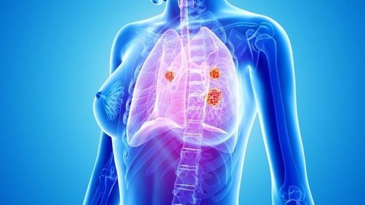 cancerpulmon_opt(1)