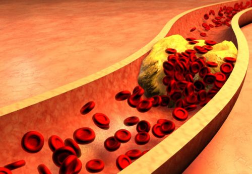 Clogged Artery with platelets and cholesterol plaque