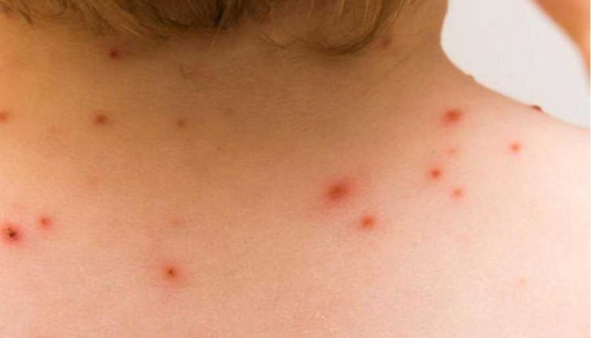 primer caso de viruela del mono en michoacan