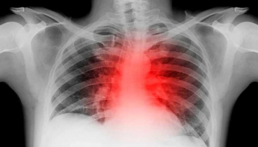 covid19-sist cardiovascular