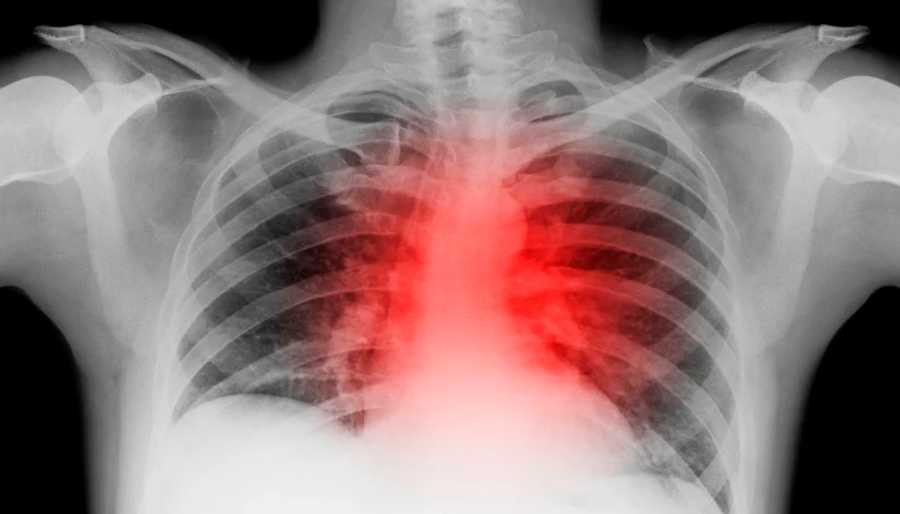 covid19-sist cardiovascular