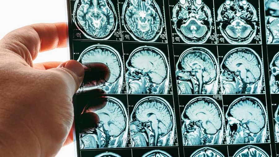 rara enfermedad amenaza Canadá-min