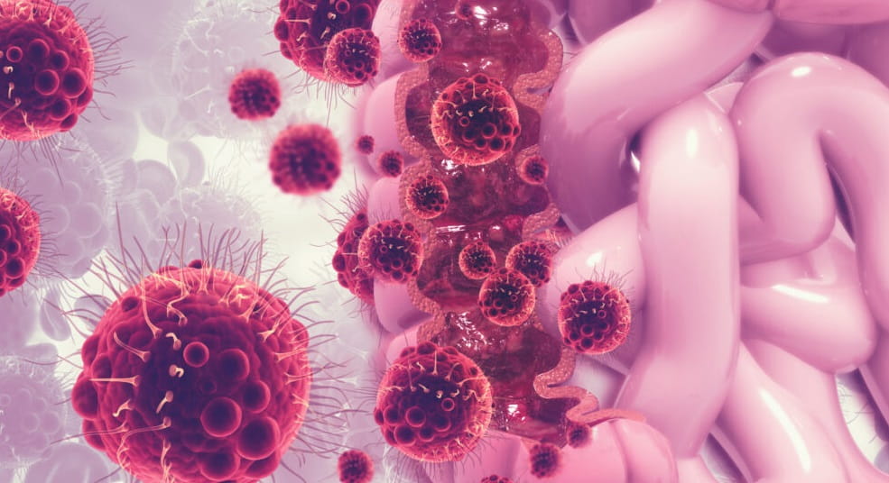 cancer colorectal-min