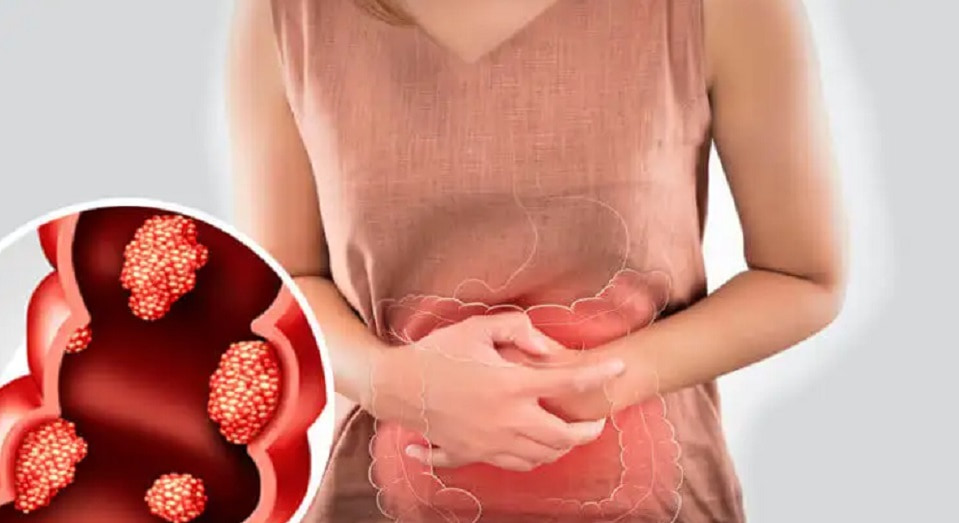 Síntomas-de-cáncer-de-colon.jpg--min