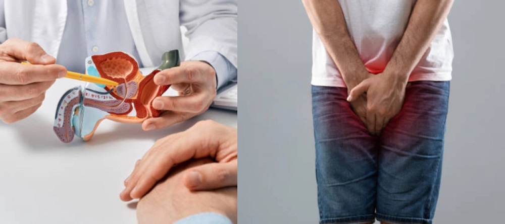 cancer prostata-min