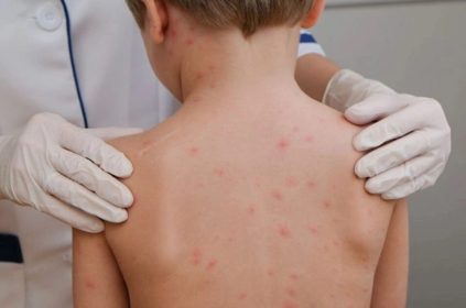 Tras recortes en salud, vuelven la tos ferina y el sarampión en México