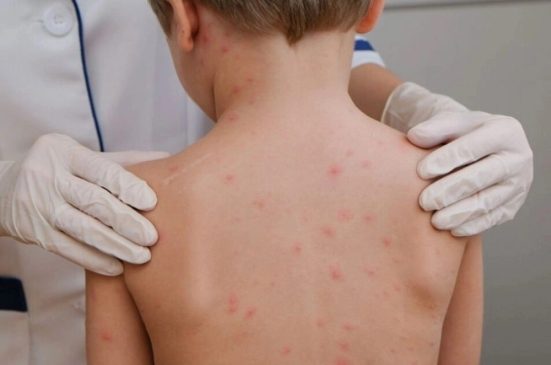 sarampion en Chihuahua-min