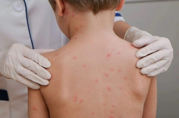 sarampion en Chihuahua-min