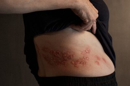 México. Uno de cada dos adultos desconoceque enfermedades crónicas aumentan riesgo de desarrollar herpes zóster