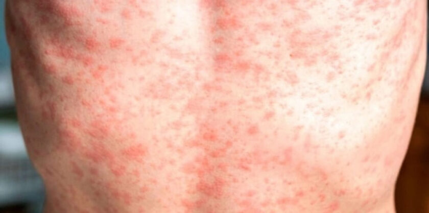 jalisco-concentra-56-de-casos-de-sarampion-en-mexico (1)