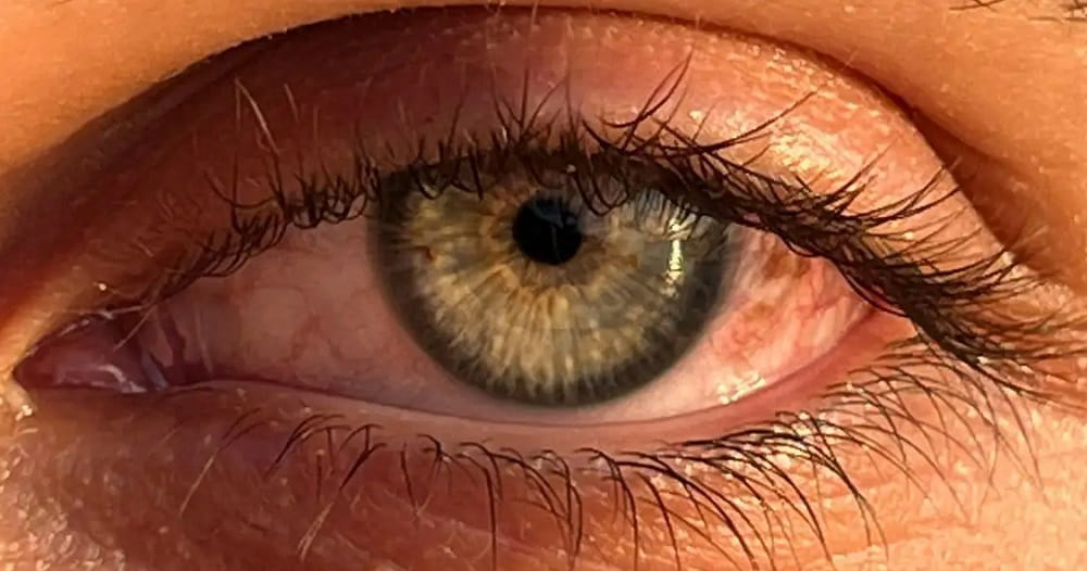 ojo-enrojecido-y-parpado-hinchado. National Geografic (1)